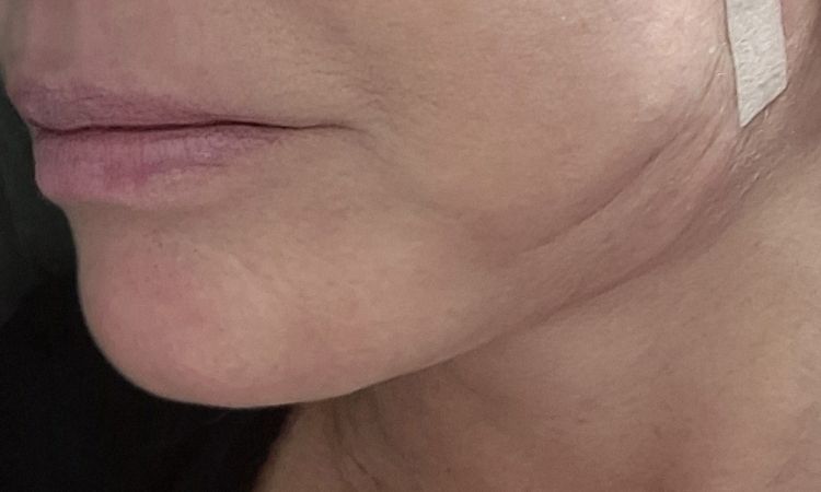 Schwellungen nach SmasNecklifting - 83206