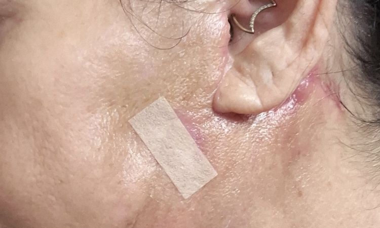 Schwellungen nach SmasNecklifting - 83207