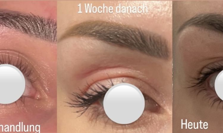 Schwellung Augenlider nach botox - 83222