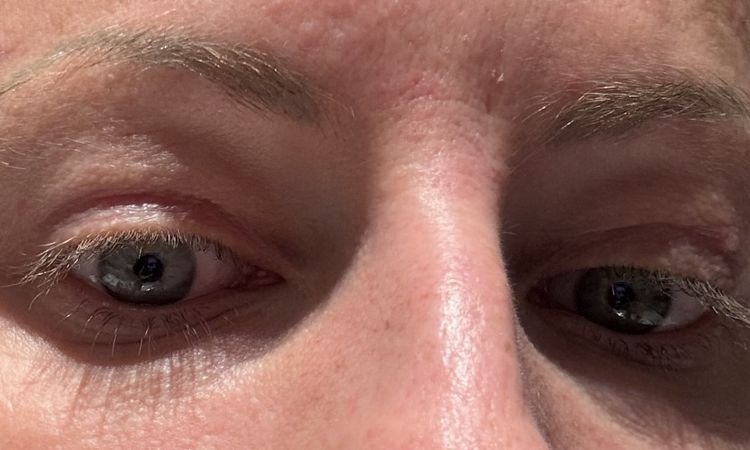 Soll das Ergebnis nach Oberlidstraffung so aussehen? - 83224