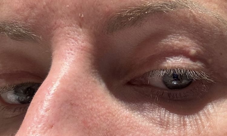 Soll das Ergebnis nach Oberlidstraffung so aussehen? - 83225