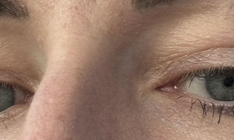 Soll das Ergebnis nach Oberlidstraffung so aussehen? - 83226