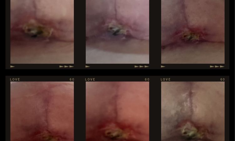 9 Wochen Post OP BV, extremes Nässen - 83243