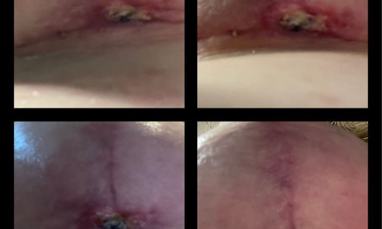 9 Wochen Post OP BV, extremes Nässen - 83244