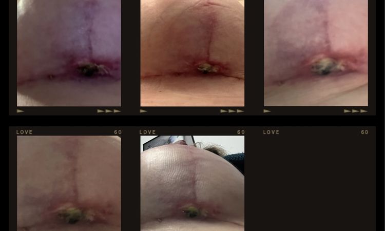 9 Wochen Post OP BV, extremes Nässen - 83245