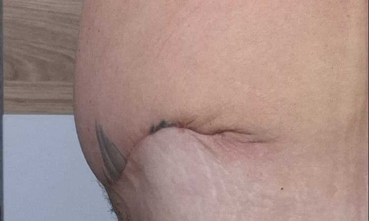 Bauchstraffung zu wenig gestrafft- nicht schöne Narbe. - 83251
