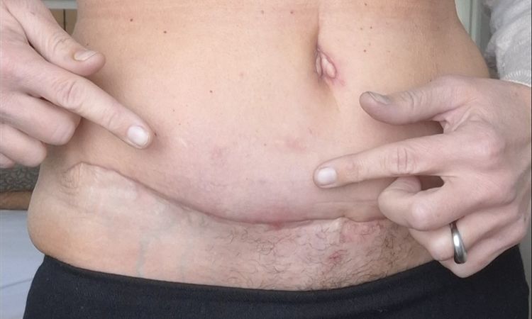 Bauchstraffung zu wenig gestrafft- nicht schöne Narbe. - 83252