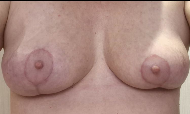 Ungleiche Brüste nach Bruststraffung und Lipofilling - 83352