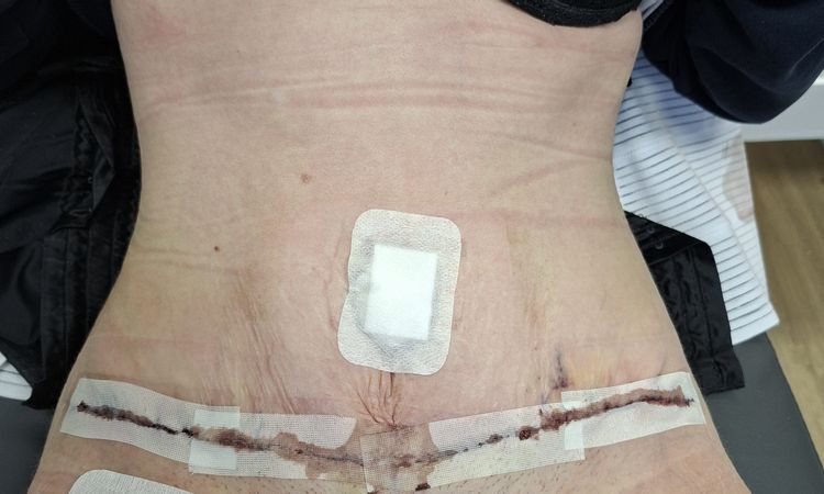 Ich habe Angst das der bauch später wieder hängt - 83359