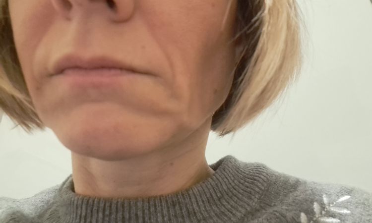 Filler mit Endolift kombinierbar,  Straffung - 83360