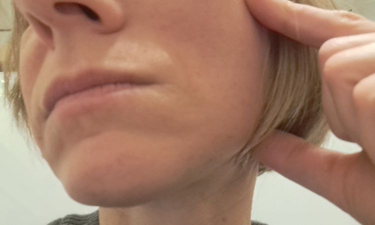 Filler mit Endolift kombinierbar,  Straffung - 83361