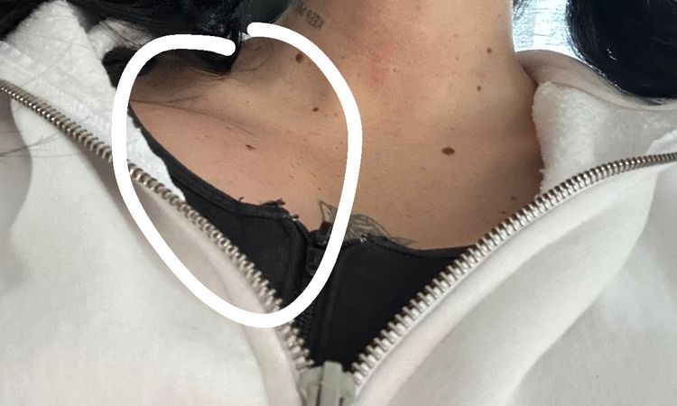 Bruststraffung mit Implantaten - 83381