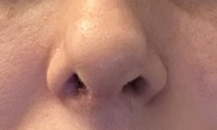 nasenlöcher asymetrisch - 83384