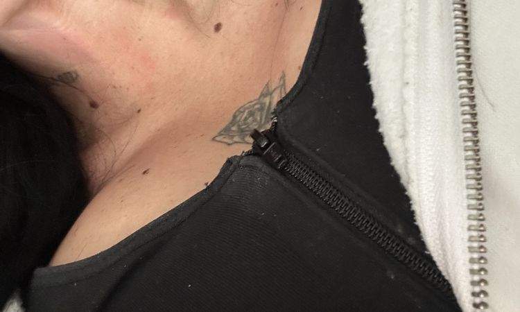 Linke Brust geschwollen - 83391