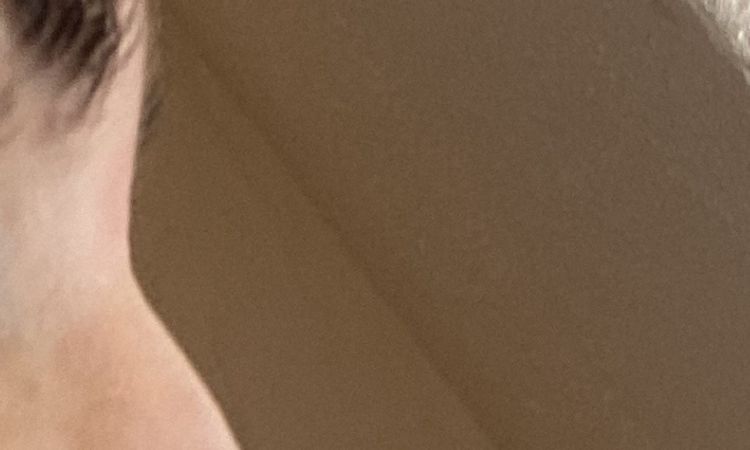 Plötzlich Höcker nach offener Nasen Op - 83393