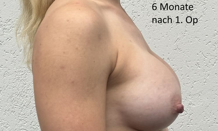 Schmerzen nach BV, 6 Monate nach Op kein Sport möglich - 83410