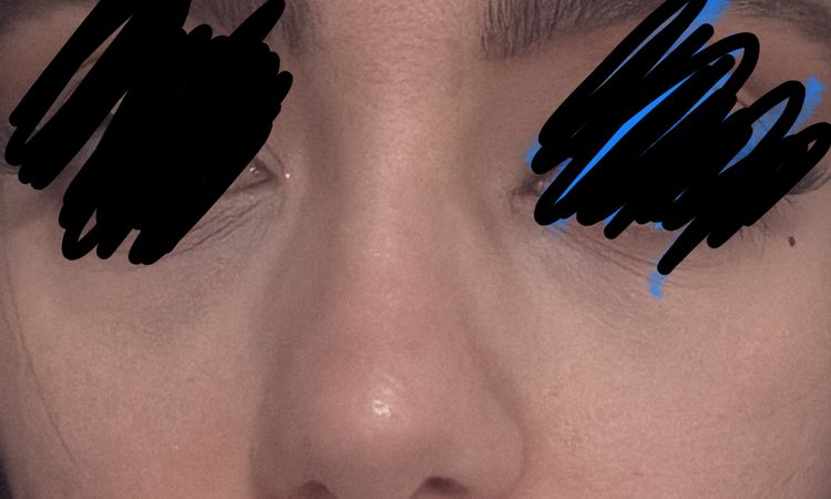 Nach Nasenop Verhärtung neben Nase/Unter Auge - 83419