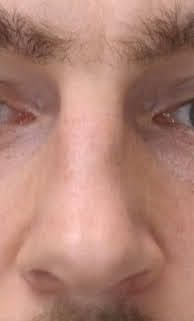 Unsymmetrische Nasenspitze nach Nasenkorrektur - 83436