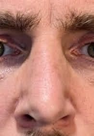 Unsymmetrische Nasenspitze nach Nasenkorrektur - 83437