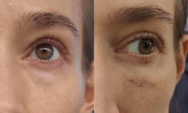 Was tun, wenn zu viel Fett entfernt am Unterlid? - 83447