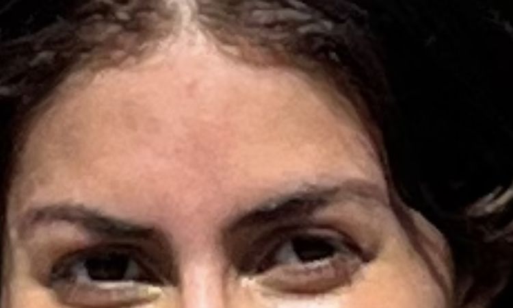 Gliding Brow Lift, Assymetrie der Augenbraue - 83452