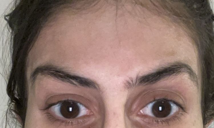 Gliding Brow Lift, Assymetrie der Augenbraue - 83454