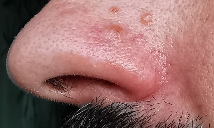 Muttermal auf Nase entfernen - 83494