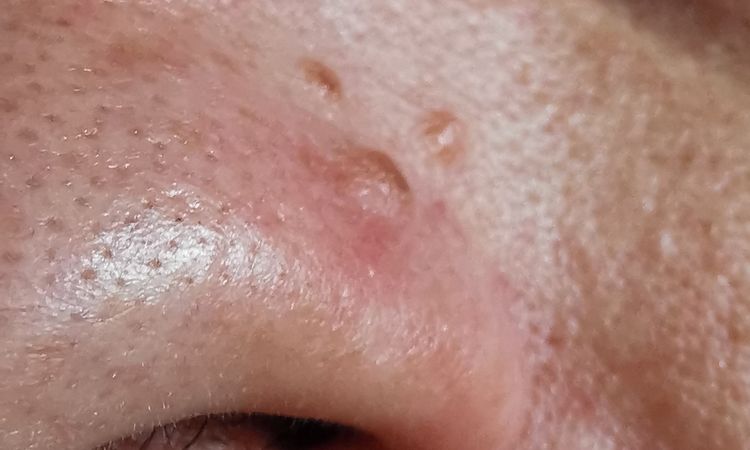 Muttermal auf Nase entfernen - 83495