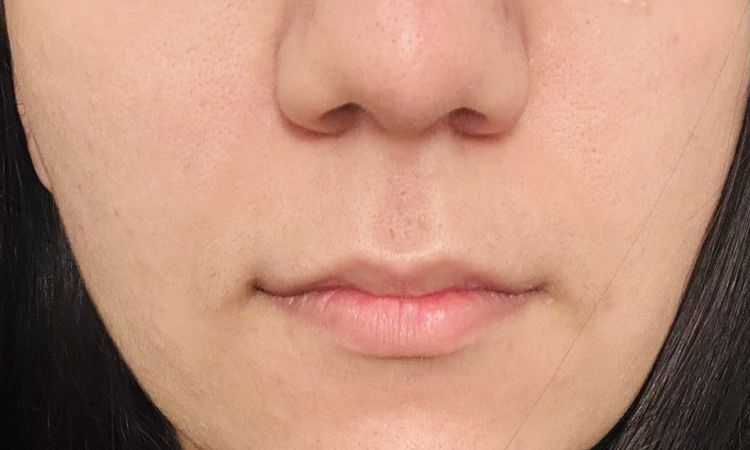 Muttermal in der Mittennase - 83498