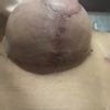 Wundheilung nach Bruststraffung + Vergrößerung mit Implantat (250cc)