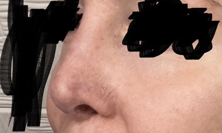 Nase ist zu klein, wie vergrößern - 83519