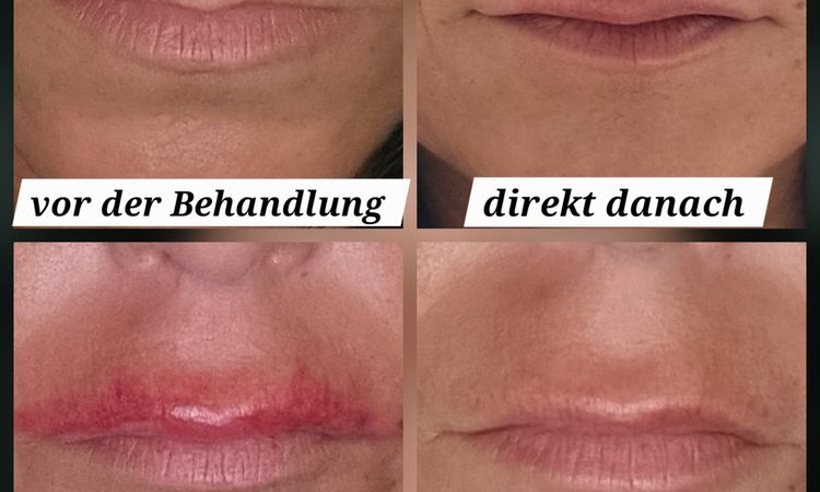 Schwellung oder Endergebnis nach Hyaloronbehandlung der Raucherfalten - 83523