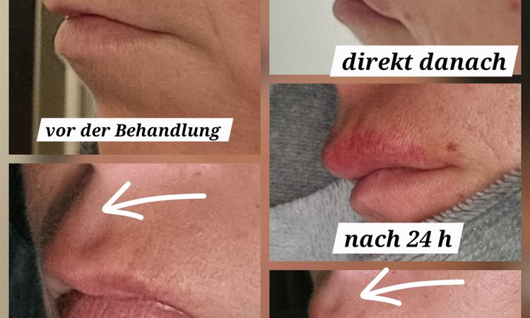 Schwellung oder Endergebnis nach Hyaloronbehandlung der Raucherfalten - 83524