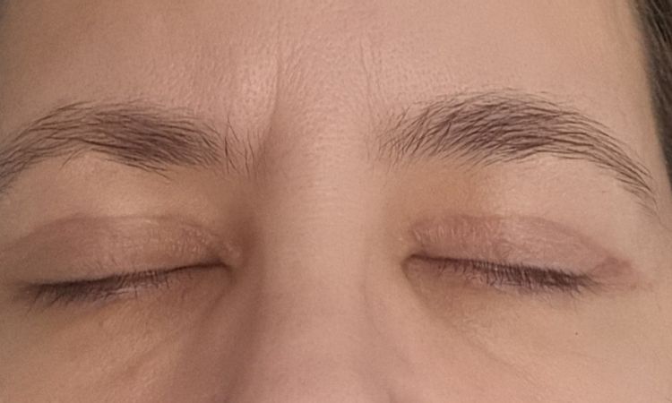 Oberlidstraffung leichte Asymmetrie - 83526