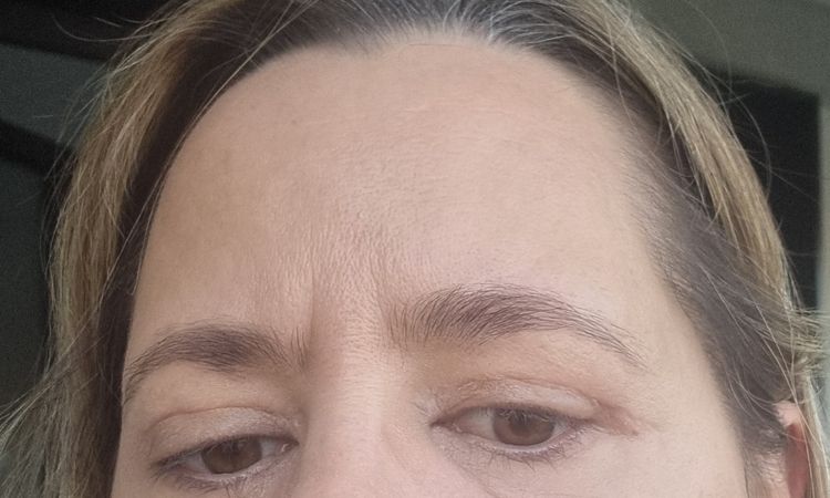 Oberlidstraffung leichte Asymmetrie - 83527