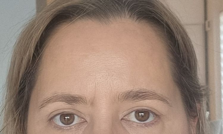 Oberlidstraffung leichte Asymmetrie - 83528