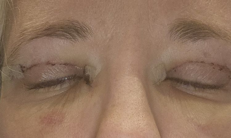 Nach Oberlifstraffung kein Lidschluss möglich - 83547