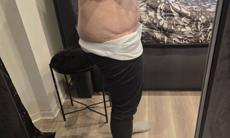 Unzufrieden nach Bauchstraffung mit Rektusdiastase - 83552