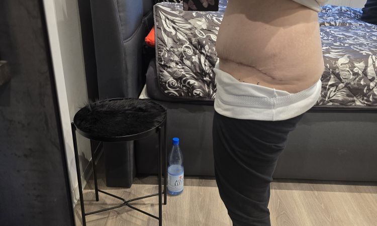 Unzufrieden nach Bauchstraffung mit Rektusdiastase - 83554