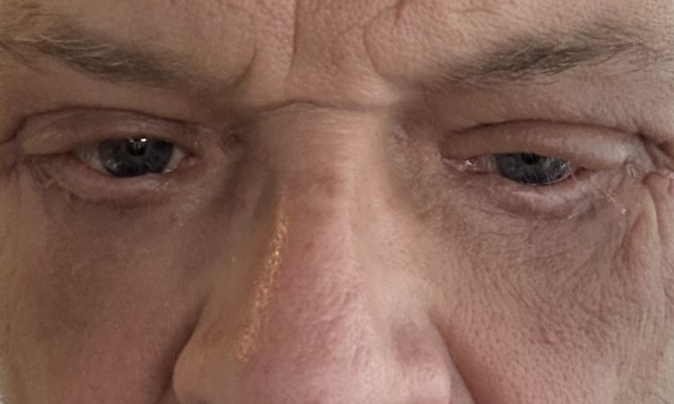 6 Monate nach Unterlidstraffung asymmetrisch - 83558