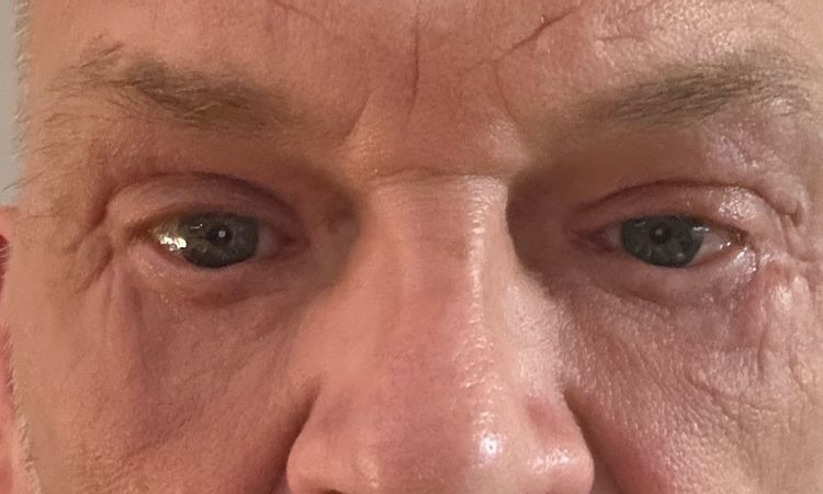 6 Monate nach Unterlidstraffung asymmetrisch - 83559