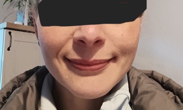 Masseterbotox vor einem Jahr und nun Asymmetrie im Wangenbereich - 83595