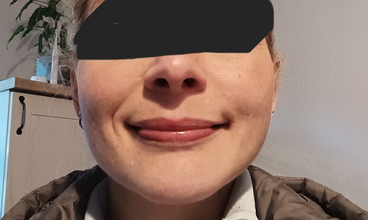 Masseterbotox vor einem Jahr und nun Asymmetrie im Wangenbereich - 83596