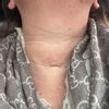Eingefallene Schilddrüsen Narbe