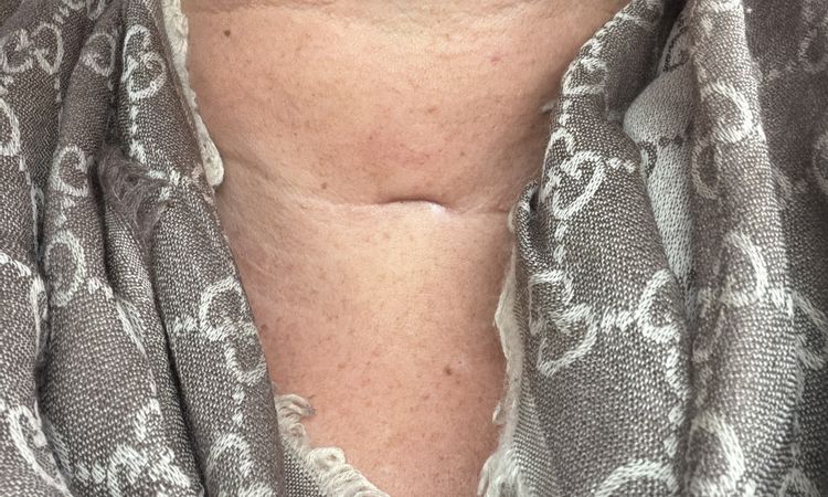 Eingefallene Schilddrüsen Narbe - 83620