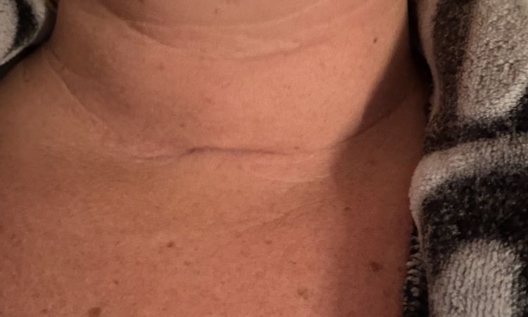 Eingefallene Schilddrüsen Narbe - 83621