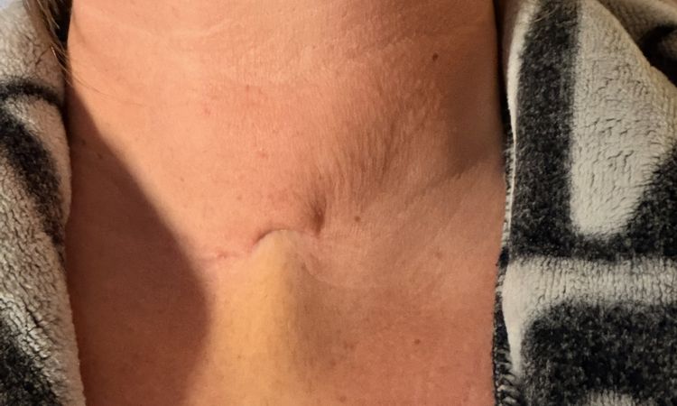 Eingefallene Schilddrüsen Narbe - 83622