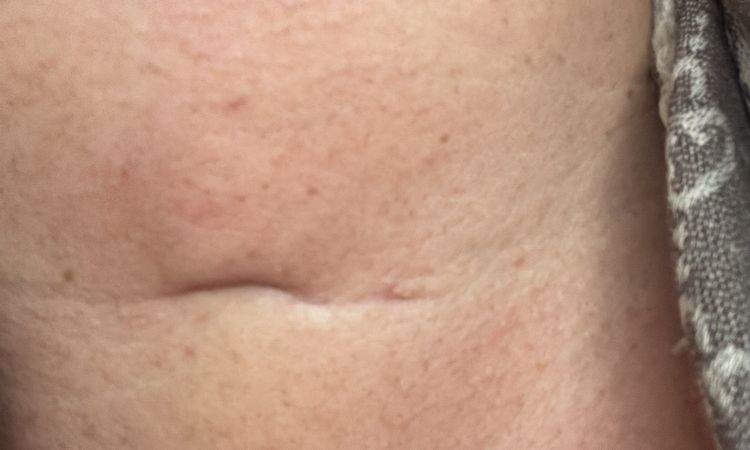 Eingefallene Schilddrüsen Narbe - 83624