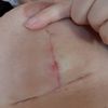 Wundheilung Brustnarbe nach knapp 5 Wochen
