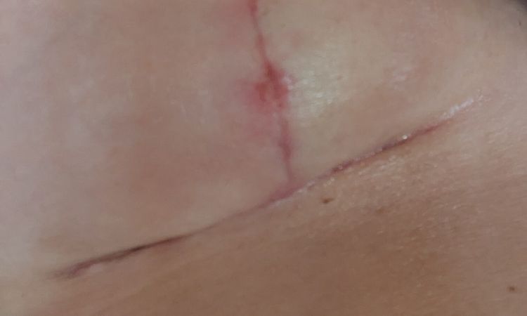 Wundheilung Brustnarbe nach knapp 5 Wochen - 83625